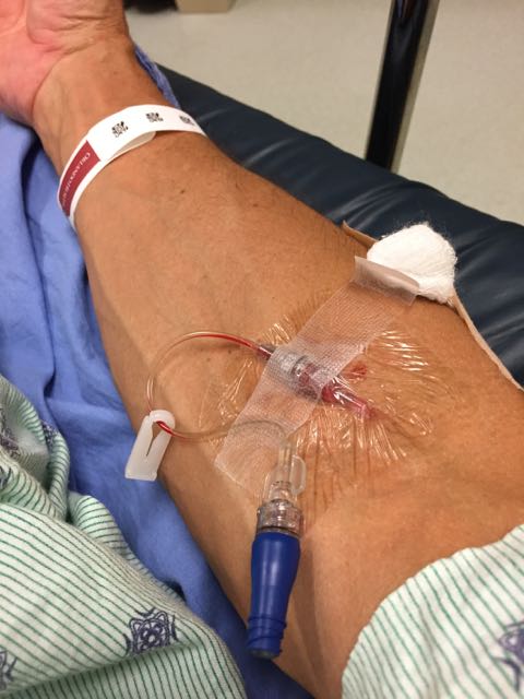 IV catheter 